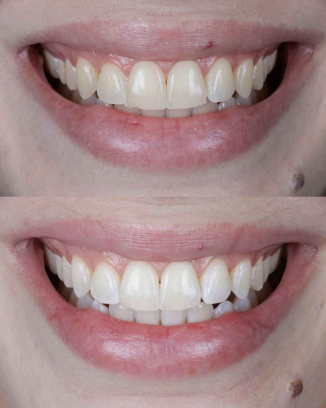 Antes e depois com melhora do contorno gengival e brilho dos dentes