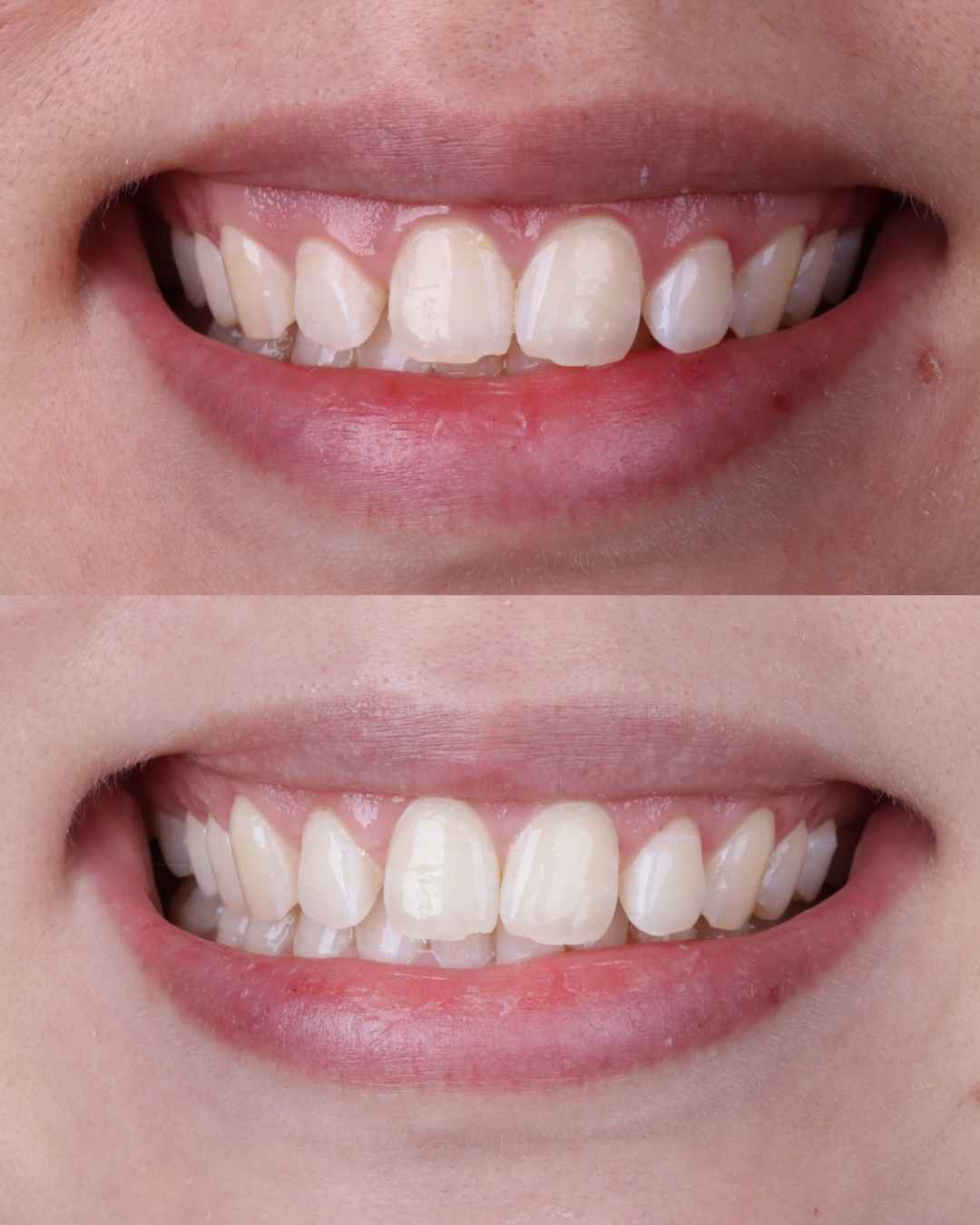 Antes e depois de harmonização do sorriso com saúde gengival
