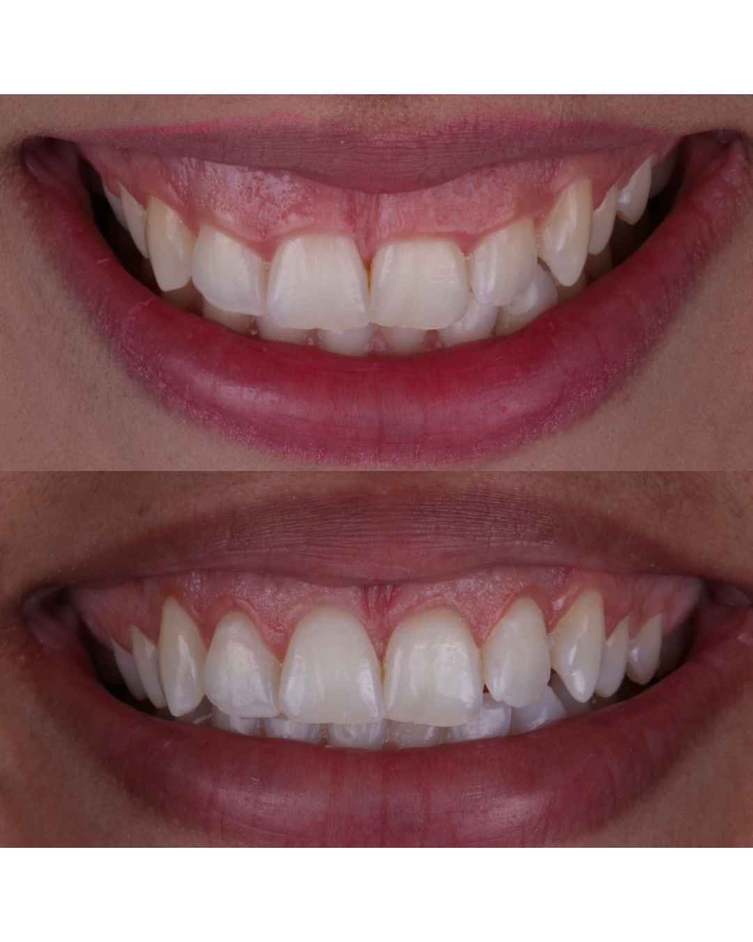 Antes e depois de tratamento de contorno gengival, com sorriso mais harmônico