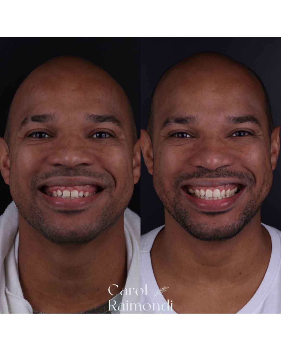 Antes e depois de paciente em vista frontal, sorriso renovado