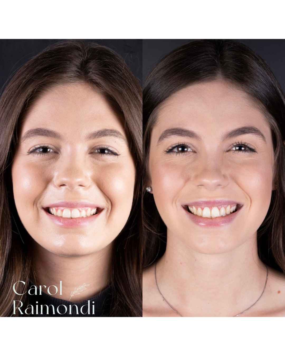 Antes e depois de paciente em vista frontal, sorriso mais equilibrado